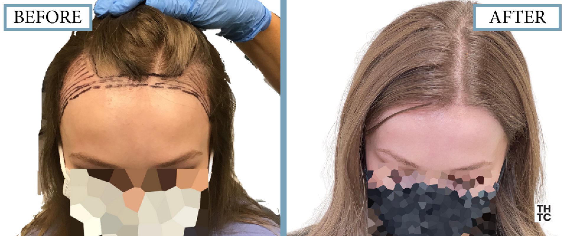 Hair Transplant Toronto